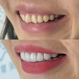 最先进的手法，最流行的美牙！！！修复黄牙、黑牙、大牙缝、残缺牙……